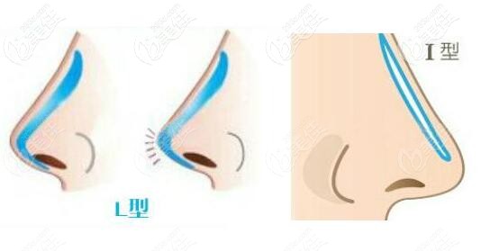 硅膠L型和I型假體哪個更安全