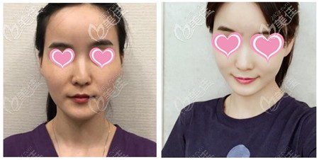 黃金微雕加脂肪填充效果