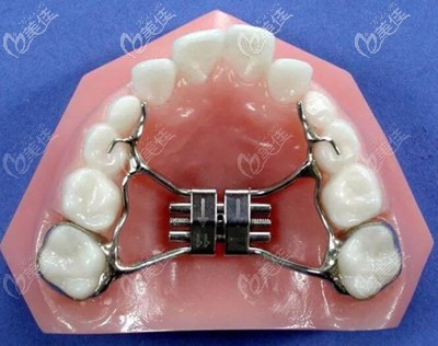 兒童牙齒擴張器