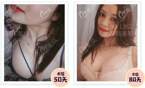 郭杰做胸技術水平蠻高的,不愧是深圳美萊隆胸厲害的醫(yī)生