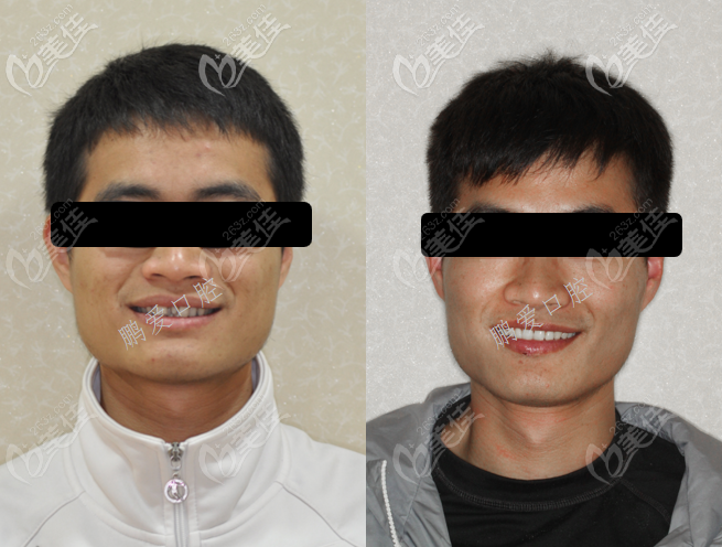 廣州博愛牙科多生牙矯正案例