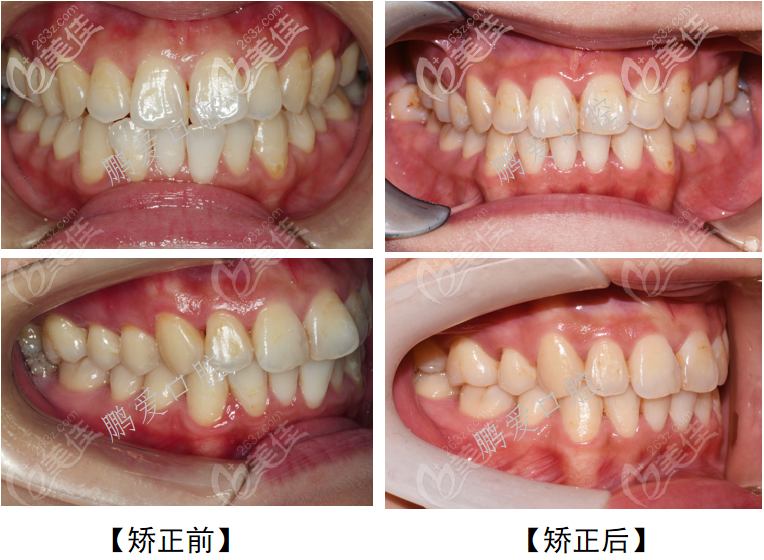 廣州博愛口腔醫(yī)院齙牙矯正案例