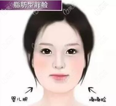 嬰兒肥型的臉胖