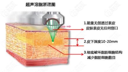 超聲溶脂的特點原理