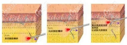 光纖溶脂的優(yōu)勢特點