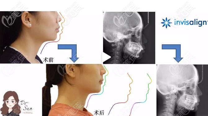 大連馬瀧齒科孫丹陽正畸案例