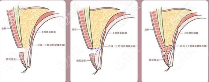 寧波壹加壹林勇雙眼皮優(yōu)勢 寧波壹加壹林勇雙眼皮優(yōu)勢