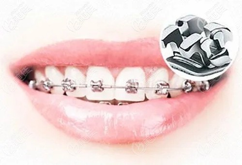 單顆烤瓷牙不影響牙齒矯正