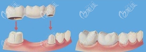 連橋牙冠影響牙齒矯正