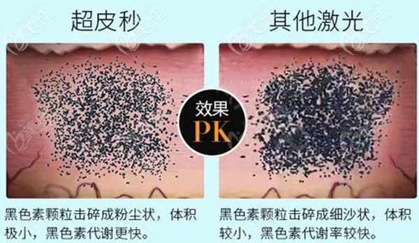 超皮秒激光祛斑和普通激光祛斑的差別