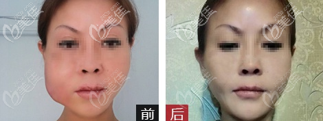 廣州美恩許揚(yáng)濱面部奧美定取出案例 廣州美恩許揚(yáng)濱面部奧美定取出案例