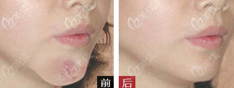 廣州美恩許揚(yáng)濱下巴奧美定取出案例 廣州美恩許揚(yáng)濱下巴奧美定取出案例