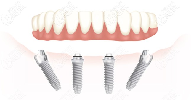 Allon4種植牙技術(shù) Allon4種植牙技術(shù)