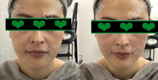 臉部3d立體網(wǎng)格提升案例效果對比圖 臉部3d立體網(wǎng)格提升案例效果對比圖