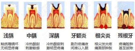 牙髓炎的發(fā)展