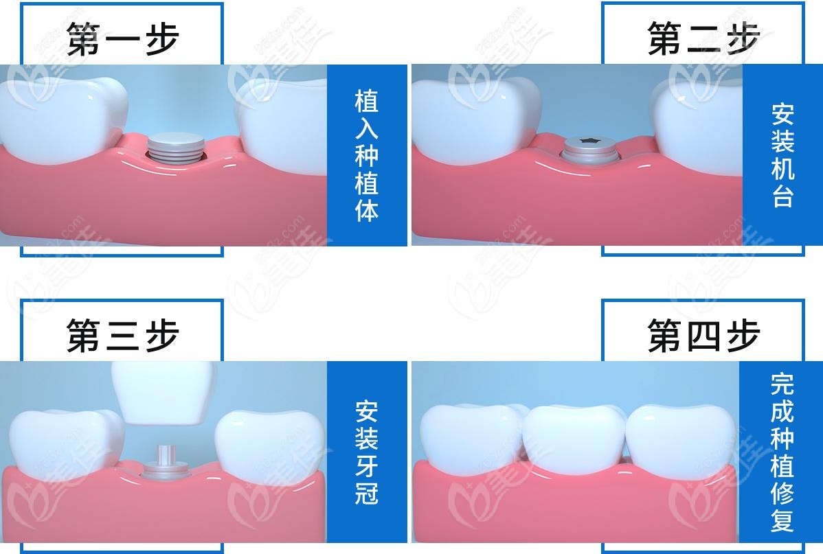 種植牙操作流程
