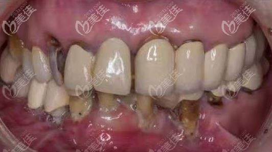 失敗的烤瓷牙 失敗的烤瓷牙