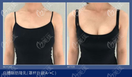 自體脂肪豐胸A杯到C杯的變化圖