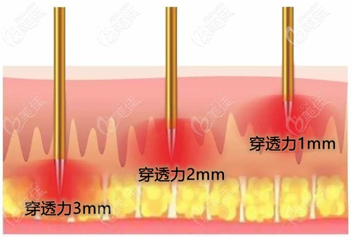微針穿透皮膚的深度