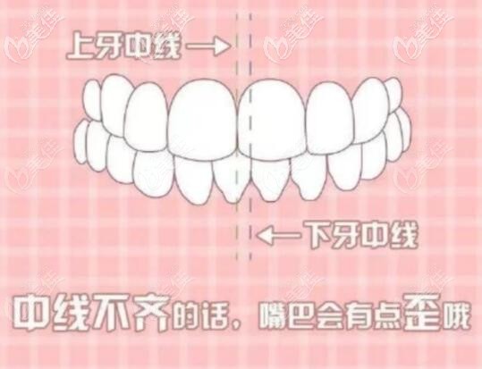 牙齒中線不齊怎么矯正
