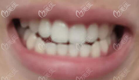 牙齒中線左偏2mm矯正效果圖