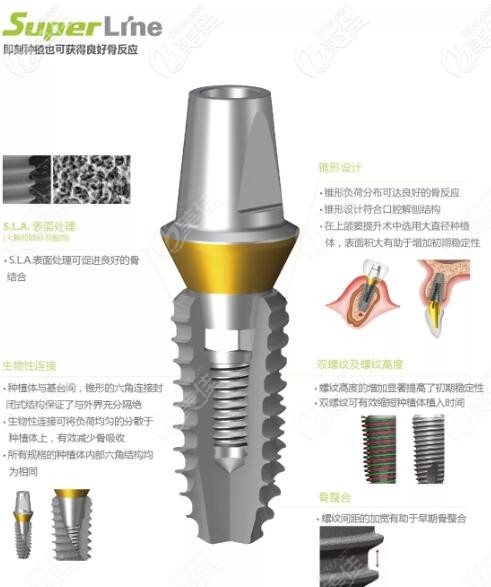 韓國登騰種植體
