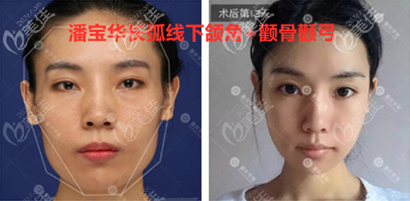 重慶華美潘寶華長(zhǎng)曲線下頜角+顴骨顴弓圖
