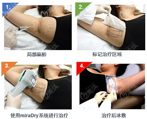 miradry微波治療腋臭的過程 miradry微波治療腋臭的過程