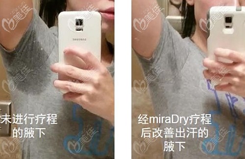 miradry微波治療腋臭的療效 miradry微波治療腋臭的療效