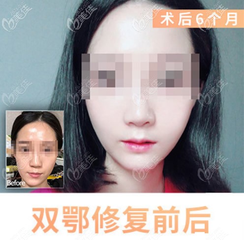 長臉做正頜手術變短臉效果圖