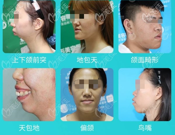 正頜手術可以哪些面部問題