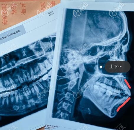 骨性凸嘴ct片<span style= 骨性凸嘴ct片<span style=