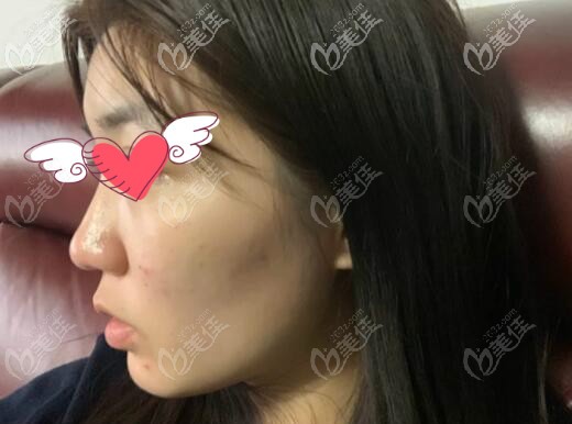 我骨性凸嘴戴牙套正畸2年后沒用,花十萬做正頜手術才恢復正常面型!