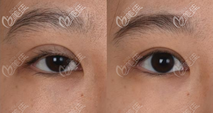 肉條眼修復(fù)效果圖