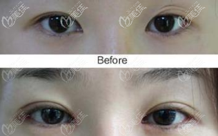 三眼皮修復(fù)效果圖