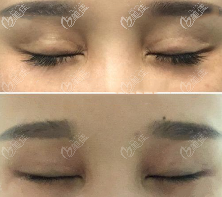 雙眼皮疤痕修復(fù)效果圖