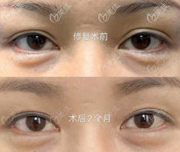 雙眼皮不自然不對(duì)稱修復(fù)效果圖