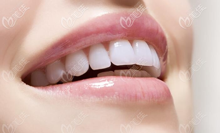 時(shí)代天使隱形矯正