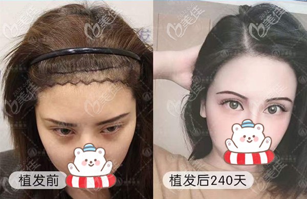 成都恒博EHB植發(fā)際線術前術后對比圖 成都恒博EHB植發(fā)際線術前術后對比圖