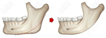 長(zhǎng)曲線下頜角截骨手術(shù)