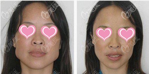 下頜角截骨+下巴截骨手術(shù)前后對(duì)比