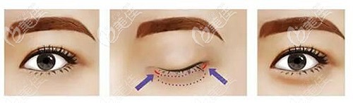 自體筋膜填充臥蠶的原理