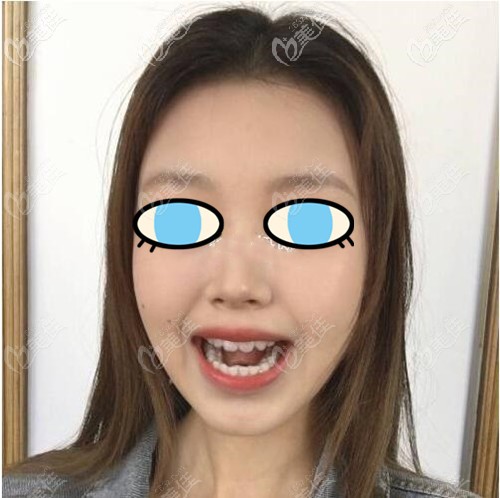 剛開(kāi)始戴隱適美的狀態(tài) 剛開(kāi)始戴隱適美的狀態(tài)