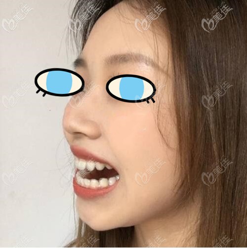 牙齒不齊導(dǎo)致嘴巴突出戴隱適美矯正有變化!才過(guò)了60天牙齒就端正了很多