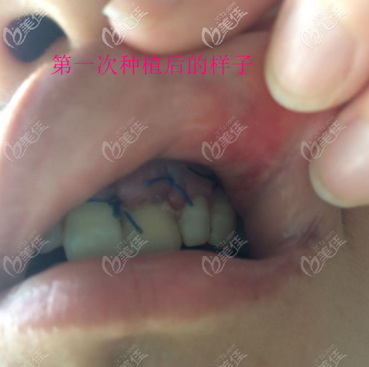 初次種植后牙齒的樣子 初次種植后牙齒的樣子