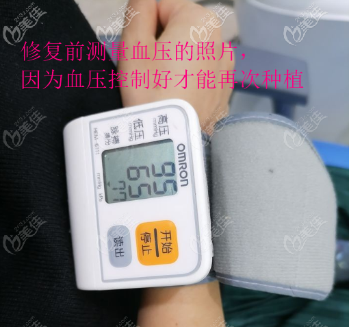 第二次骨粉種植修復(fù)前測(cè)量血壓 第二次骨粉種植修復(fù)前測(cè)量血壓