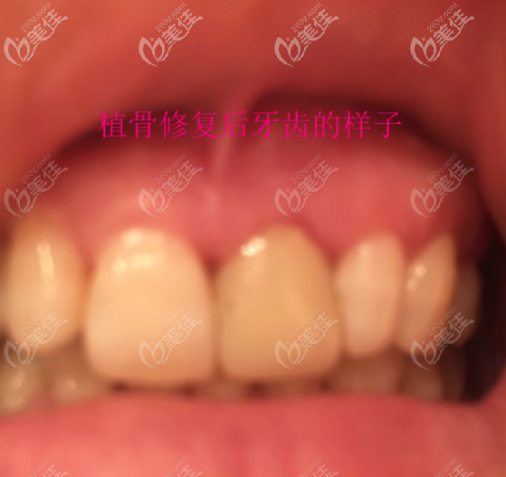 我種植牙8年后牙齒痛還出血，并且牙骨吸收的厲害需要植骨修復