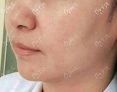 小切口拉皮手術3年以后的效果 小切口拉皮手術3年以后的效果