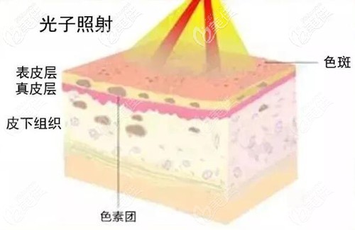 熬夜皮膚變差也可以做光子嫩膚