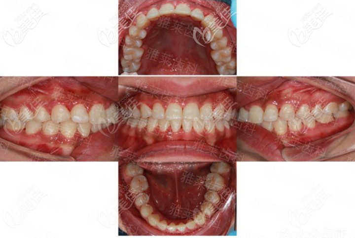 杭州雅萊隱適美矯正后